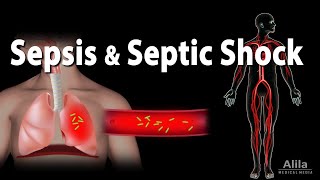 Sepsis Signs and Symptoms and CRITICAL THINKING [upl. by Laden]