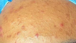 Extraction boutons pimples et acné kystique cystic acne sur le front [upl. by Guidotti45]