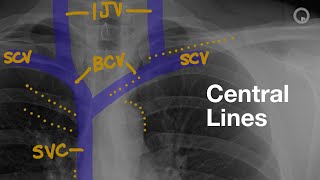 Central Lines on CXR [upl. by Adnarrim]