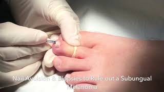 Nail Biopsy to Rule out melanoma under the nail [upl. by Rodriguez853]