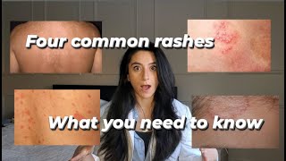 Four common rashes and everything you need to know about them [upl. by Lentha]