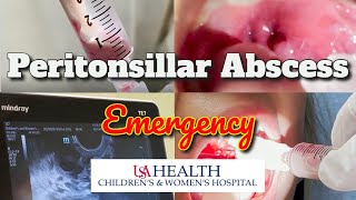 Peritonsillar Abscess Emergency and Needle Aspiration [upl. by Yziar]