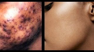 How to Remove Dark amp Black Spots on Face  Get Flawless Glowing Skin  superWOWstyle [upl. by Freiman]