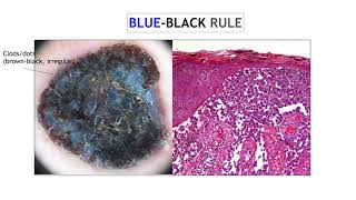 Nodular melanoma  Dr Ketty Peris [upl. by Thalassa]