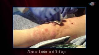 WCW Abscess Incision and Drainage [upl. by Enortna]