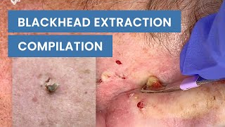 Extraction Satisfaction Blackhead Removal  CONTOUR DERMATOLOGY [upl. by Euqinahs445]