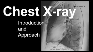 Chest Xray Introduction and Approach [upl. by Eenhpad737]