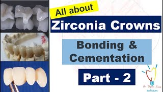 Zirconia Crowns  CEMENTATION vs BONDING [upl. by Suiratnauq821]