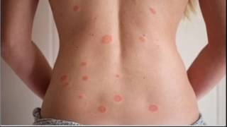 Pityriasis Rosea [upl. by Derfniw987]