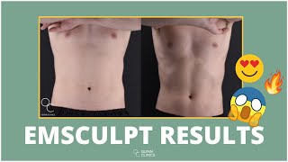 EMSCULPT  Before amp After’s   Is it WORTH it  amp Does it WORK  Quinn Clinics Bristol [upl. by Ardnaed]