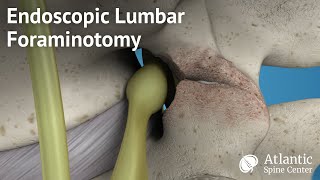 Endoscopic Lumbar Foraminotomy [upl. by Charlie]