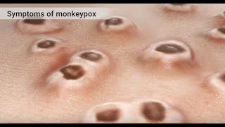 Mpox Monkeypox Animation [upl. by Adnohser]