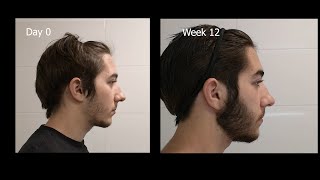 Minoxidil Beard Growth  3 Month Transformation  Timelapse BEFORE and AFTER [upl. by Nirik260]