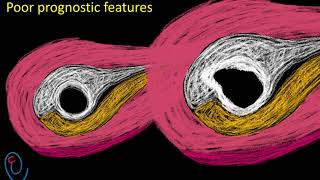 Early pregnancy ultrasound explained  GS  YS and FP [upl. by Airec]