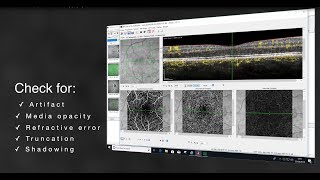 Systematic Interpretation of OCT Angiography Images [upl. by Artemis]