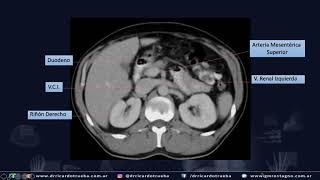 TOMOGRAFIA AXIAL BASICA DE ABDOMEN Y PELVIS [upl. by Hsakaa]