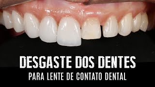 Desgaste dos dentes para lentes de contato dentais e facetas em porcelana [upl. by Sylvan577]