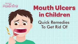 How To Get Rid Of A Canker Sore In 2 HoursEasy Trick [upl. by Aicyla105]