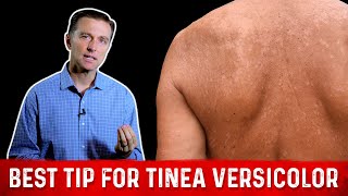 Natural Skin Fungus Tinea Versicolor Home Remedies – Dr Berg [upl. by Ethelyn868]