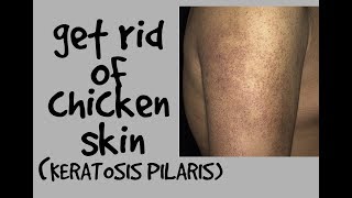 HOW TO GET RID OF CHICKEN SKIN KERATOSIS PILARIS DR DRAY [upl. by Llenyt633]