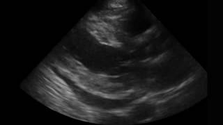 Heart PLAX Moderate Pericardial Effusion [upl. by Ahsiened117]