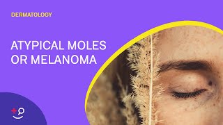 Atypical Moles or Melanoma The ABCDEs Dermatology [upl. by Morril]