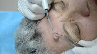 Intra dermal nevus  removal by highfrequency electrosurgery [upl. by Astrea]