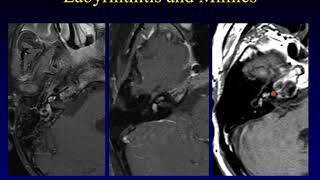 Temporal Bone Pathology 6 Hearing Loss Part 1 [upl. by Akinuahs]