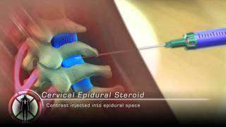 Cervical Epidural Steroid Injection Procedure Animation [upl. by Riocard]