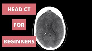 How to Read a Head CT  Radiology Approach [upl. by Grizelda265]