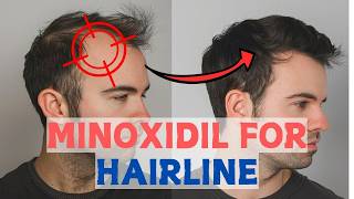 Minoxidil for Frontal Baldness  Restore Your Hairline [upl. by Lrad624]