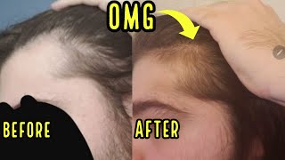 INSANE HAIR GROWTH FROM ORAL MINOXIDIL INCREDIBLE RESULTS [upl. by Elokin]