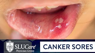 Canker Sores Vs Cold Sores – Dr Berg on Mouth Sores [upl. by Nekal]