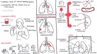 Lung Cancer  Overview [upl. by Hubble]