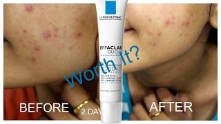 La Roche Posay Effaclar Duo Review  Worth it [upl. by Cliff]