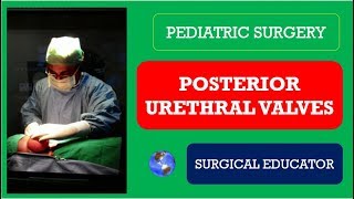 POSTERIOR URETHRAL VALVES  How To DIAGNOSE amp TREAT Pediatric Surgery [upl. by Pressman]