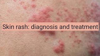 Skin Rash diagnosis and treatment [upl. by Ikey]