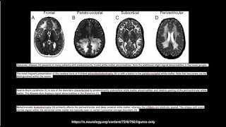 Myelination milestones Approach [upl. by Bambi]