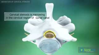 Cervical Stenosis Definition [upl. by Liddie]