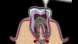 Wurzelbehandlung beim Zahnarzt [upl. by Okramed]