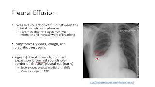 Acute Pulmonary Pathophysiology 2 Pleural Effusion [upl. by Garihc]