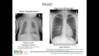 Approach to Pediatric Chest XRays [upl. by Ange720]