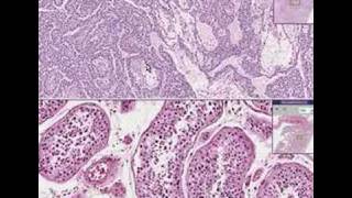 Histopathology TestisEndodermal sinus tumor yolk sac tumo [upl. by Koressa733]