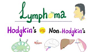 Hodgkin’s Lymphoma vs NonHodgkins Lymphoma  Comparison  Hematology and Oncology [upl. by Dam]