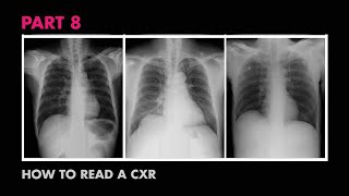 Diaphragms and Pleural Effusion  How to Read a Chest XRay Part 8  MEDZCOOL [upl. by Jagir771]