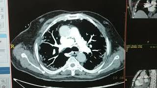 CT PULMONARY ANGIOGRAPHY [upl. by Orecul119]