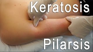 Keratosis Pilaris Clear  Brilliant Treatment FT Eric Smith  BLUSH Beverly Hills [upl. by Eegnat]