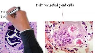 Sarcoidosis  Pathology  Immunology  Med Vids made simple [upl. by Airamanna]