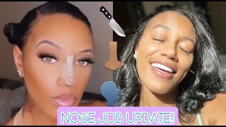 NOSE JOB UPDATE  Ethnic Rhinoplasty Recovery  Istanbul Turkey [upl. by Nannahs]