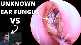 Ear Fungal Infection VS Audiologist [upl. by Macfarlane]